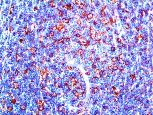 IHC of HLA-DR alpha-chain on an FFPE Lymphoma Tissue