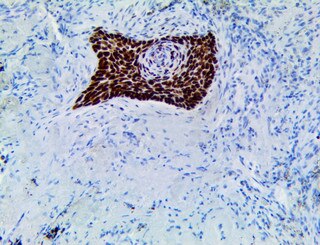HMGA2 Antibody Immunohistochemistry on an FFPE Lung Squamous Cell Carcinoma Tissue