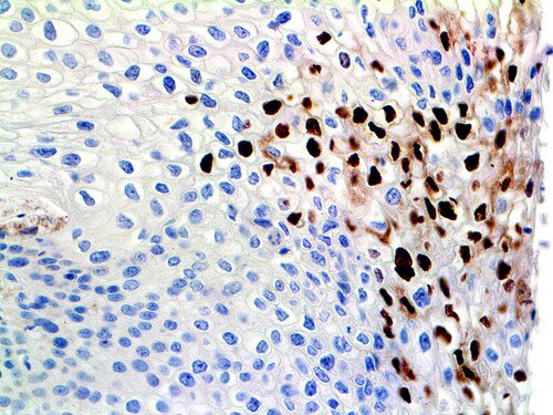 IHC of HPV on an FFPE LSIL of the Cervix Tissue