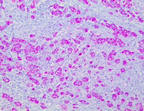 IHC of PolyDetector HRP Fuchsia staining on a FFPE Ductal Breast Carcinoma Tissue