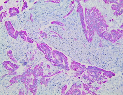 IHC of PolyDetector HRP Fuchsia staining on a FFPE Pancreatic Adenocarcinoma Tissue
