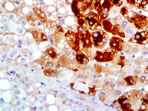 IHC of HBsAg on an FFPE Infected Liver Tissue