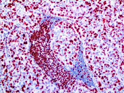 IHC of Ki-67 on Breast Carcinoma