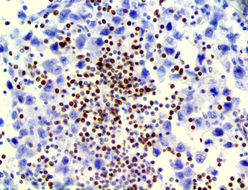 IHC of LEF1 on a FFPE Testicular Carcinoma Tissue