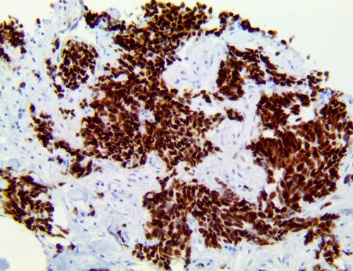 IHC of INSM1 on a FFPE Lung Neuroendocrine Carcinoma Tissue