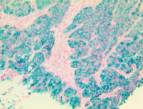 TintoFast MART-1 Antibody Immunohistochemistry on a Frozen Acetone-Fixed Melanoma Tissue
