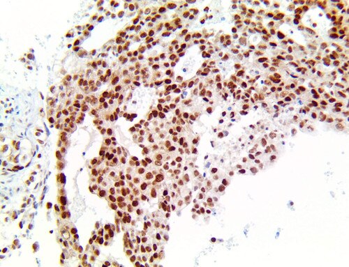IHC of MGMT Antibody Immunohistochemistry on an FFPE Lung Adenocarcinoma Tissue