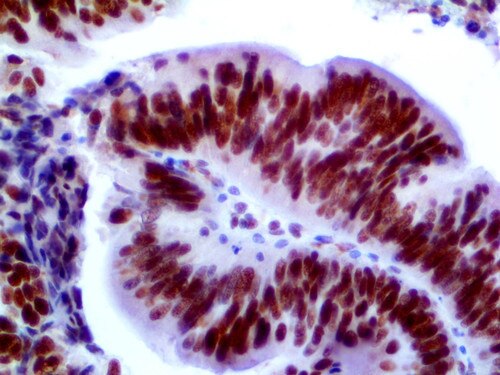 IHC of MLH1 on a FFPE Colon Carcinoma Tissue
