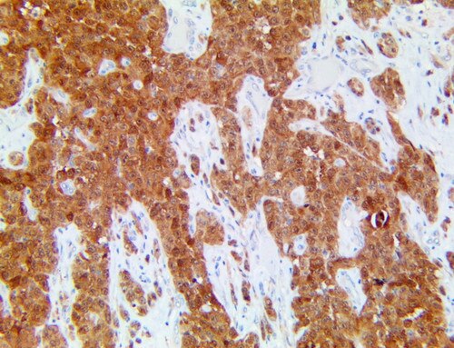 HC of MTAP on a FFPE Melanoma Tissue
