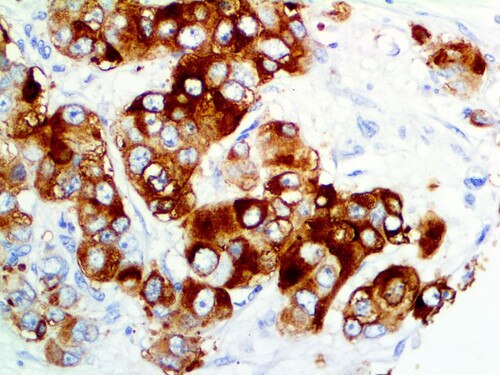 IHC of MUC1 on an FFPE Breast Carcinoma Tissue