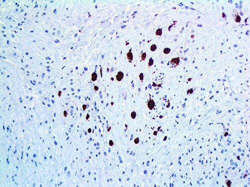 IHC of Myoglobin on a FFPE Rhabdomyosarcoma Tissue