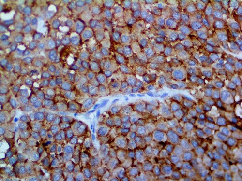 IHC of Melanoma Cocktail on an FFPE Melanoma Tissue