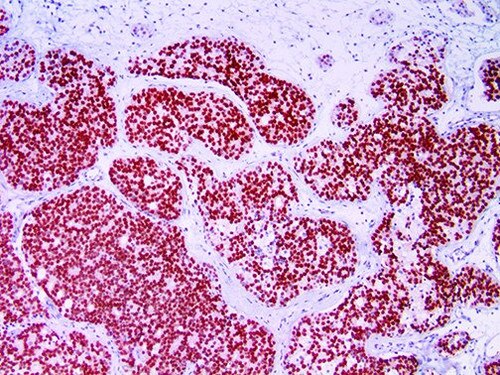IHC of NKX3.1 on an FFPE Prostatic Carcinoma Tissue