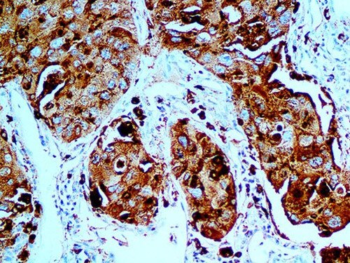 IHC of Napsin A on a FFPE Lung Carcinoma Tissue