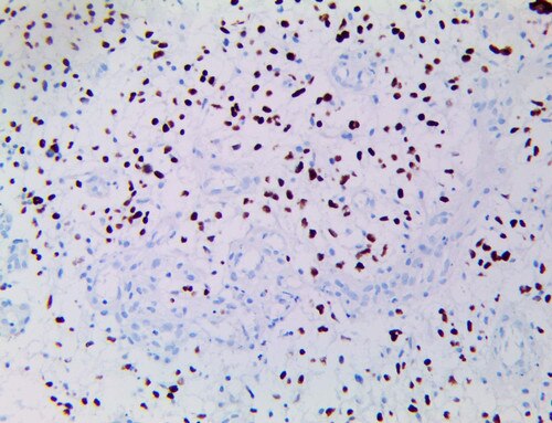 IHC of OLIG2 on a FFPE Neuroblastoma Tissue