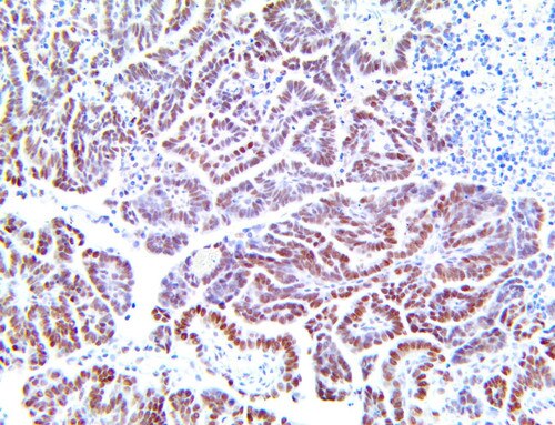 ARID1A Antibody Immunohistochemistry on an FFPE Ovarian Serous Carcinoma Tissue