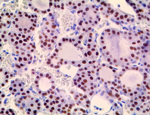 IHC of PAX-8 on a FFPE thyroid Tissue