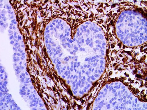 IHC of PDGFR-B on an FFPE Breast Tissue