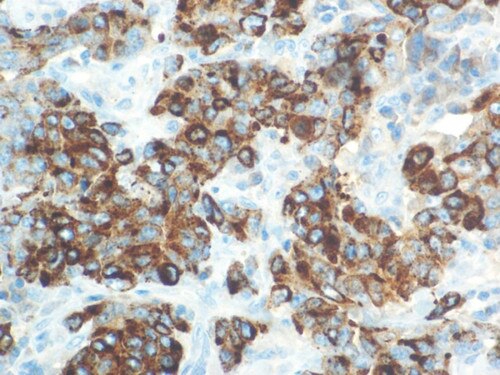 IHC of Alpha-Fetoprotein on a FFPE Yolk-Sac Carcinoma Tissue