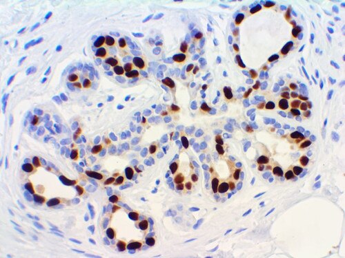 Progesterone Receptor (PR) antibody Immunohistochemistry on a FFPE Breast Carcinoma Tissue