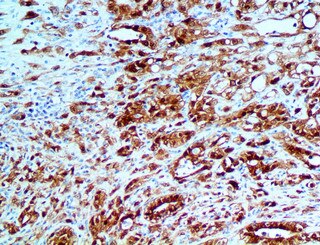 IHC of Calretinin on a FFPE Mesothelioma Tissue
