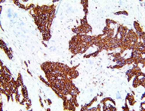 IHC of Somatostatin Receptor 2/SSTR2 on a FFPE Lung Neuroendocrine Carcinoma Tissue