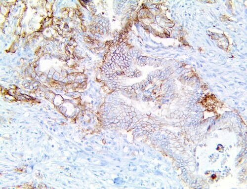 IHC of Trop-2/EGP-1 on a FFPE Pancreatic Adenocarcinoma Tissue