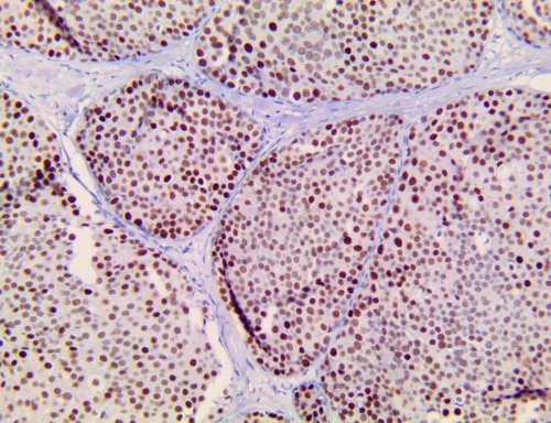 IHC of TRPS1 on a FFPE Ductal Carcinoma In Situ Tissue