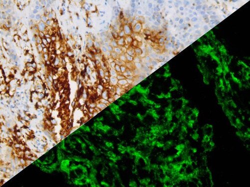 IHC & IF of VZV on a FFPE Infected Skin Tissue