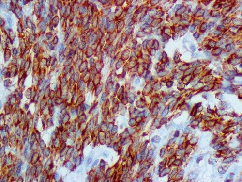 IHC of bcl-2 on an FFPE Follicular Lymphoma Tissue