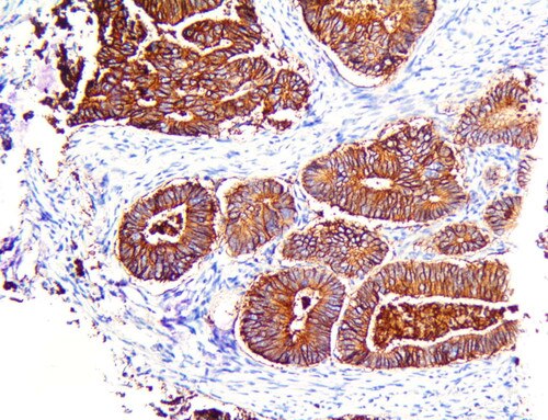 IHC of Claudin-4 on a FFPE Colon Adenocarcinoma Tissue
