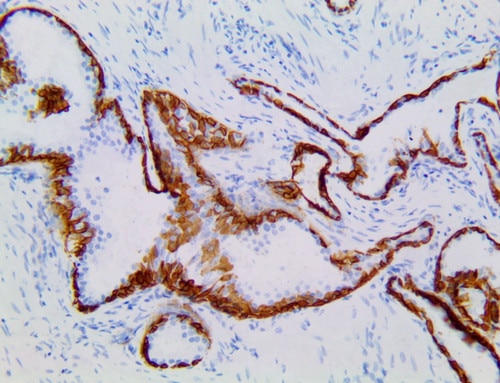 IHC of Cytokeratin 5 & 6 on a FFPE Prostate Tissue