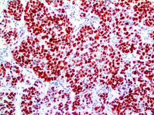 IHC of p27 on an FFPE Breast Adenocarcinoma Tissue