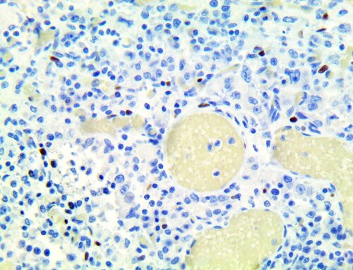 pan-TRK Antibody Immunohistochemistry on an FFPE Diffuse Gastric Carcinoma Tissue