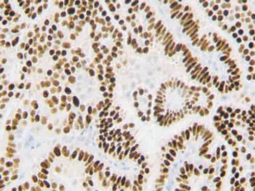 Progesterone Receptor (PR) RBT-2 Antibody Immunohistochemistry on a FFPE Breast Carcinoma Tissue