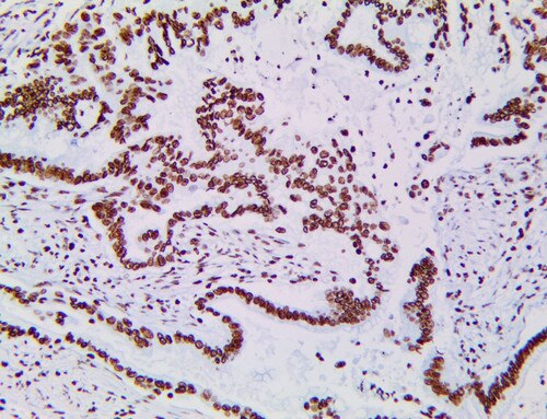 IHC of Tri-Methyl-Histone H3(Lys27)/H3K27Me3 on a FFPE Pancreatic Adenocarcinoma Tissue